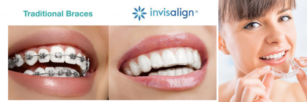 Invisible Braces Treatment in Kumbakonam