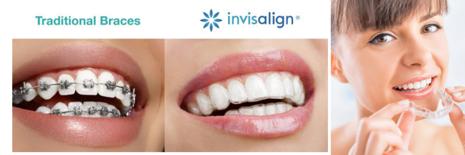 Invisible Braces Treatment in Kumbakonam - Banu Dental