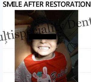 Pediatric Dental Treatments