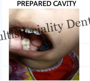 Pediatric Dentistss Treatment in Kumbakonam
