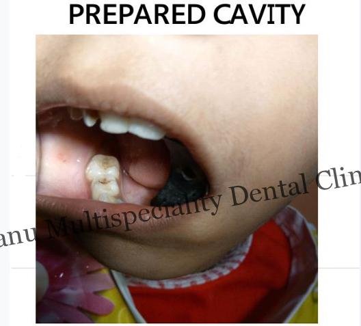 pediatric dentistss treatment in kumbakonam