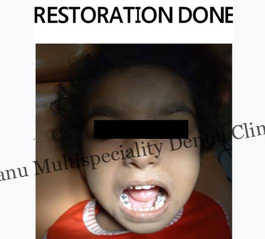 Pediatric Dentistss Treatment in Kumbakonam
