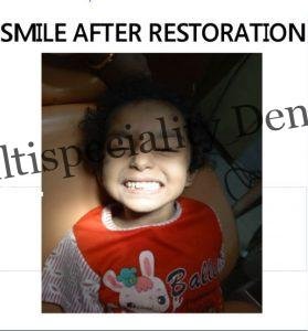 Pediatric Tooth Cleaning & Fluoride