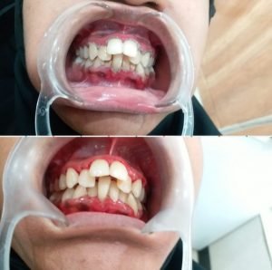 Why Dental Implants Are a Long-Term Solution for Missing Teeth