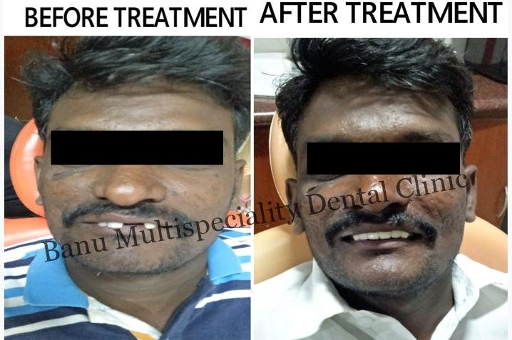 Tooth Crown & Dental Bridges Treatment in Kumbakonam