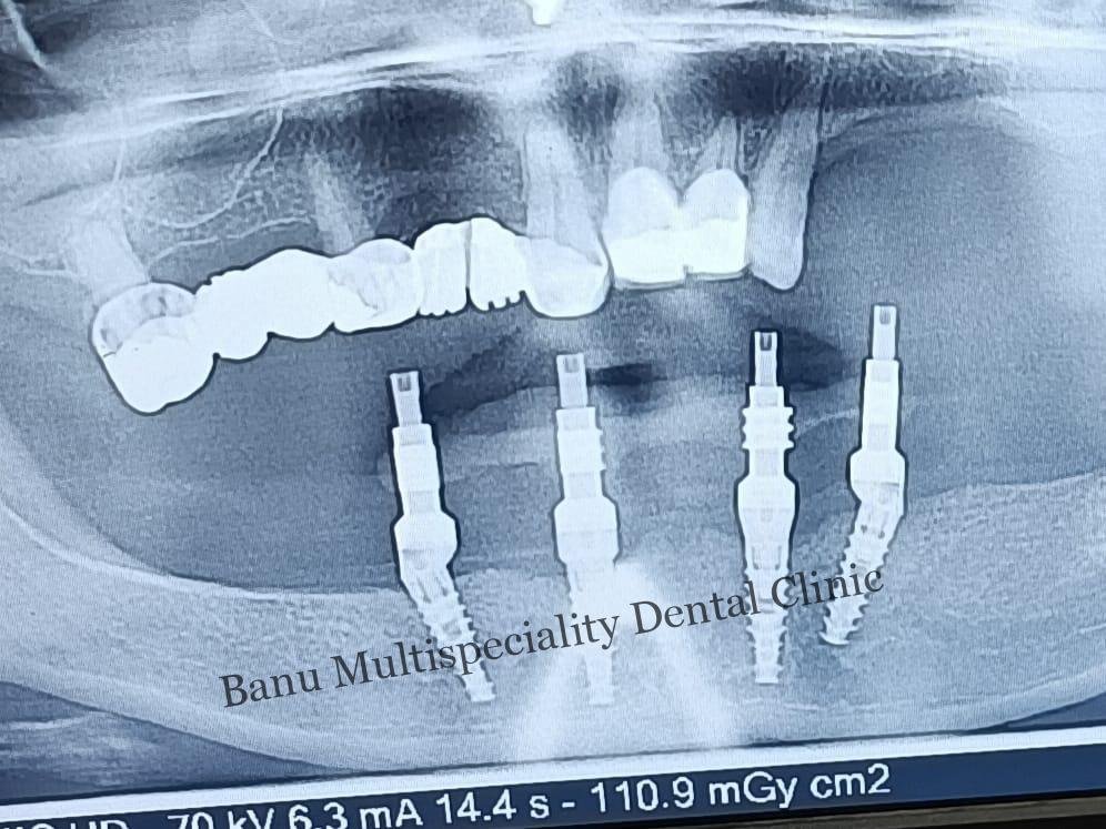 Dental Implants Treatment in Kumbakonam