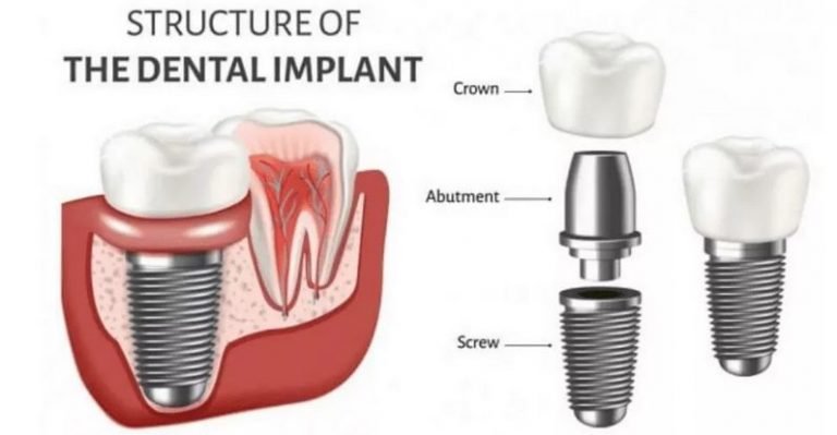 Dental Implants Treatment in Kumbakonam