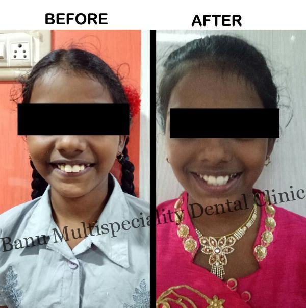 Orthodontic Treatment in Kumbakonam