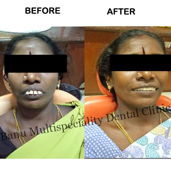 After Tooth Extraction: Essential Dos and Don’ts