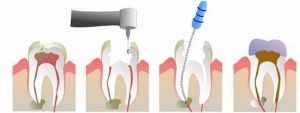 How to Prepare for a Root Canal Treatment