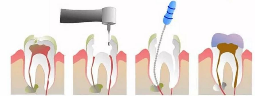 Top 5 Questions Patients Ask About Root Canal Therapy