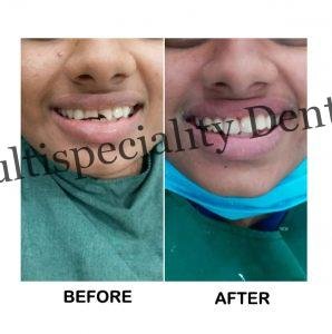Smile Makeovers Treatment in Kumbakonam