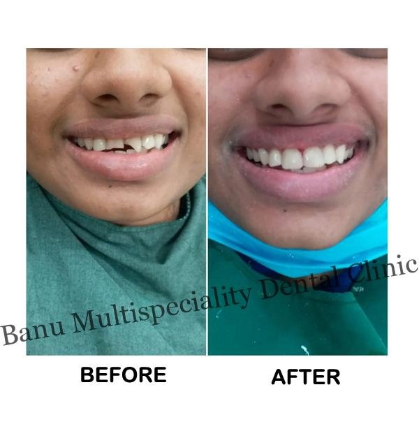 Smile Makeovers Treatment in Kumbakonam
