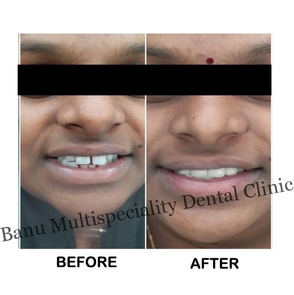 Smile Makeovers Treatment in Kumbakonam