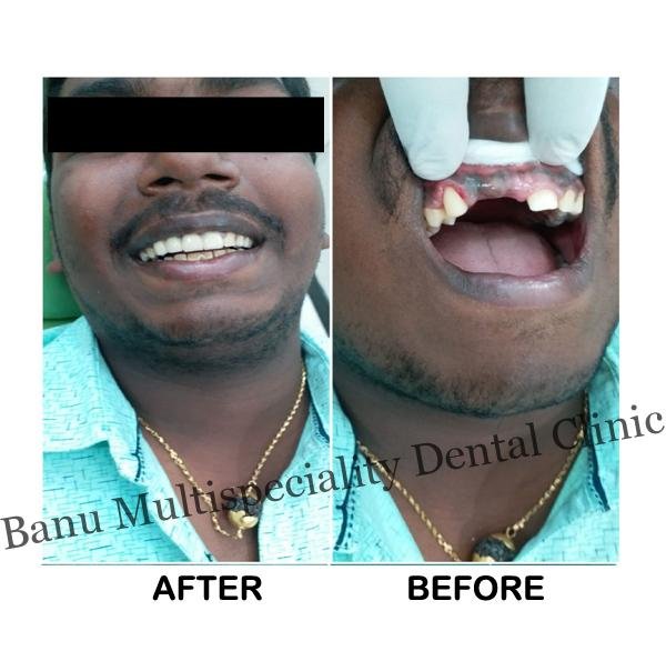 Dental Treatments in Kumbakonam