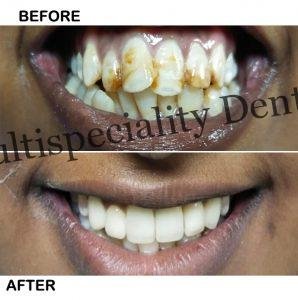 Teeth Whitening Treatment in Kumbakonam