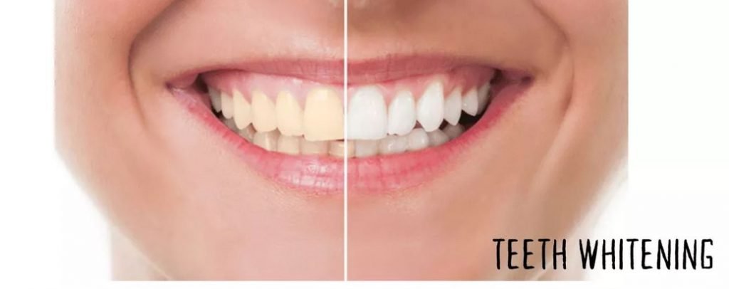 Teeth Whitening Treatment in Kumbakonam