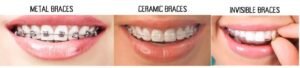 Orthodontic Treatment for Kids