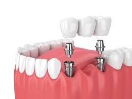 Affordable Dental Implants in Kumbakonam