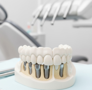 Veneers vs Crowns for Smile Makeover | Key Differences