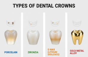 What are the types of dental crowns and which is best?