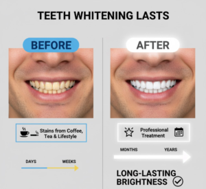  How long does teeth whitening last?